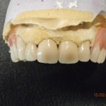 Μερικές οδοντοστοιχίες